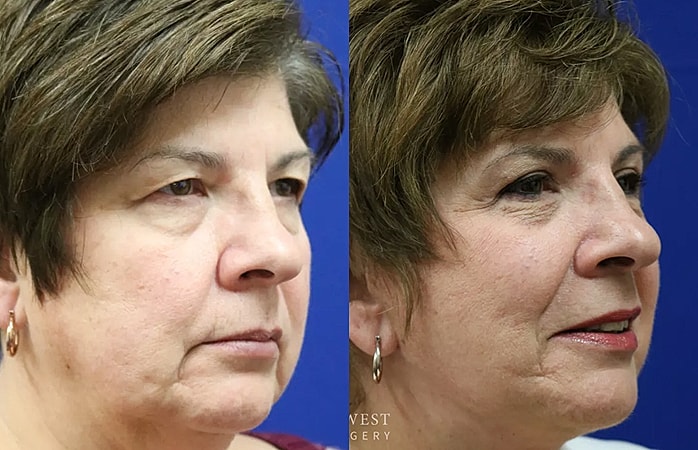 Before and after facial rejuvenation transformation.