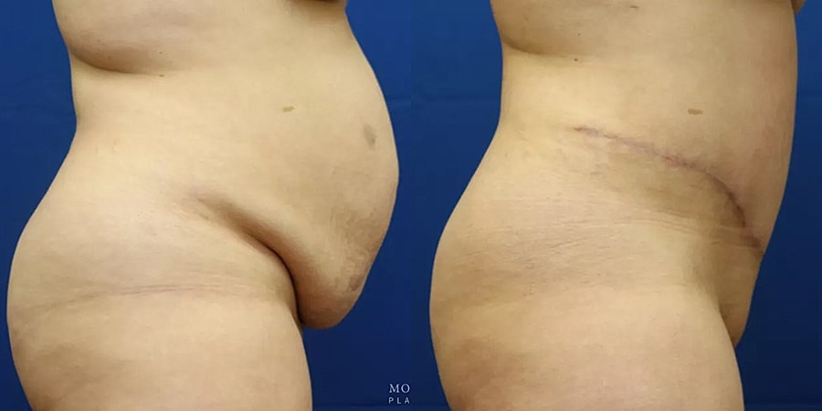 Before and after body contouring comparison.