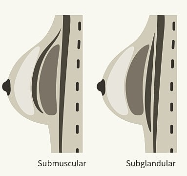 Breast implant placement techniques comparison illustration.