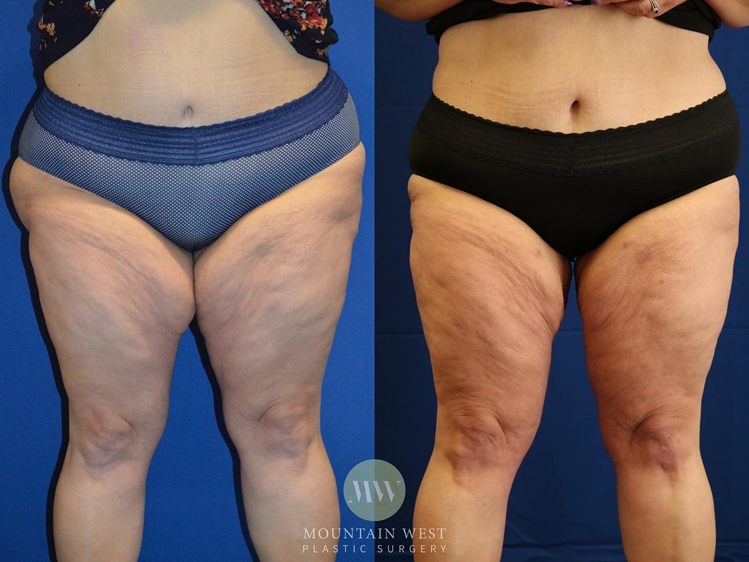 Liposuction Before & After