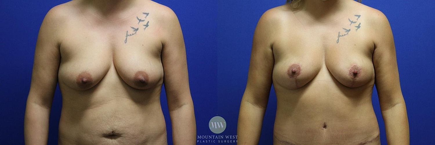 Liposuction Before & After