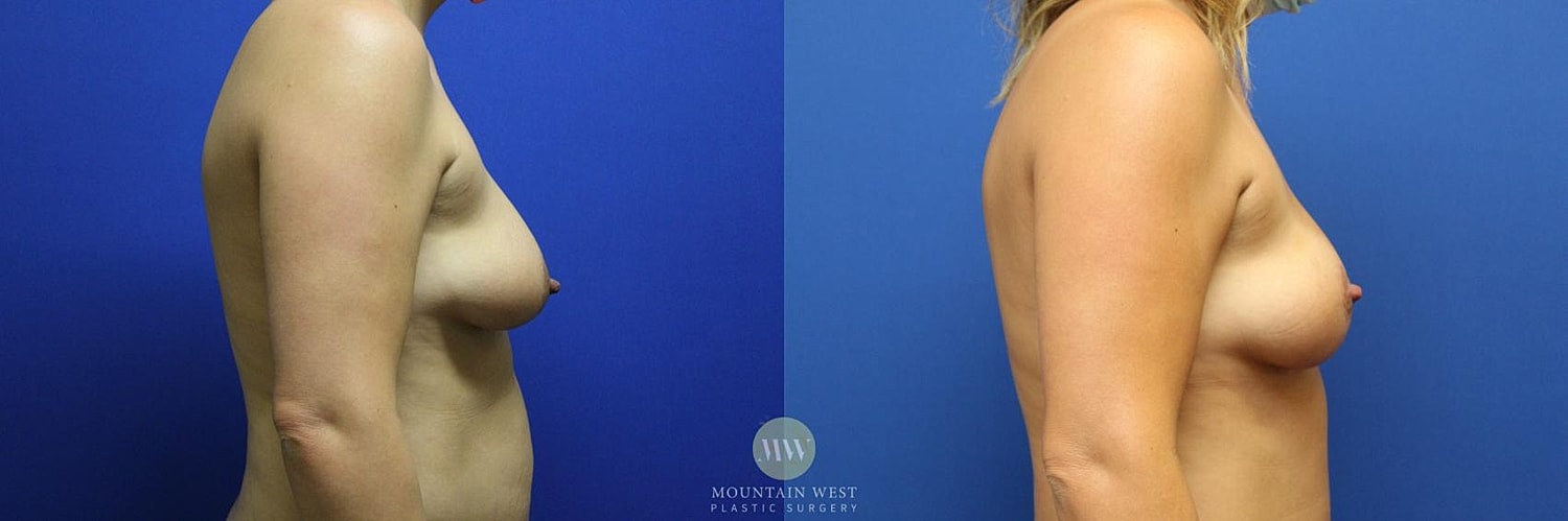 Liposuction Before & After