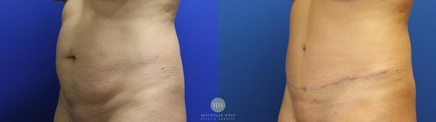 Liposuction Before & After