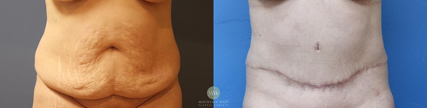 Liposuction Before & After