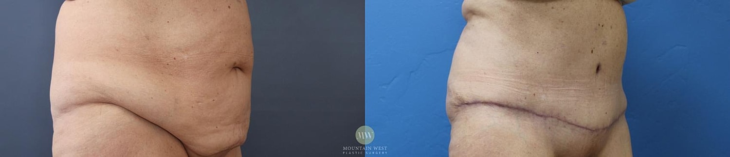 Liposuction Before & After