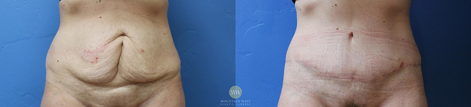 Liposuction Before & After