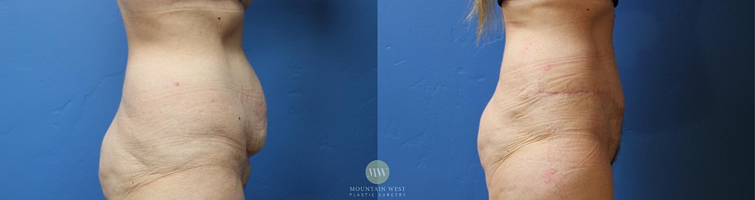 Liposuction Before & After