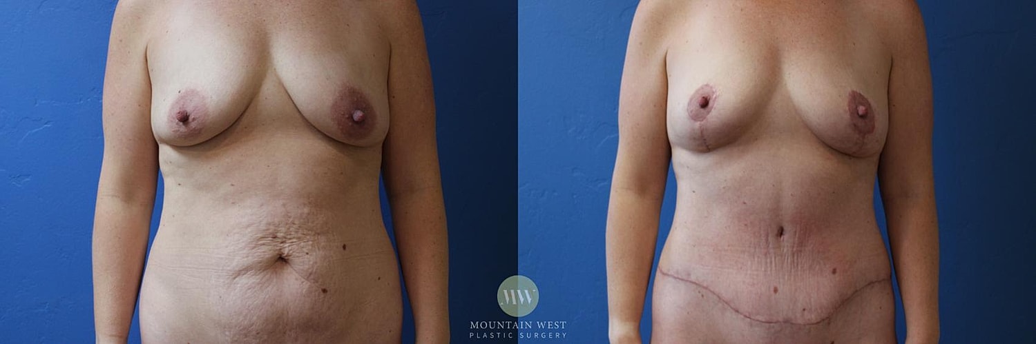 Liposuction Before & After