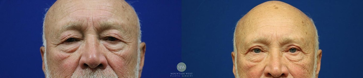 Blepharoplasty Before & After