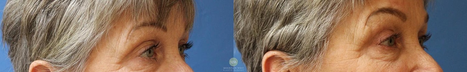 Blepharoplasty Before & After