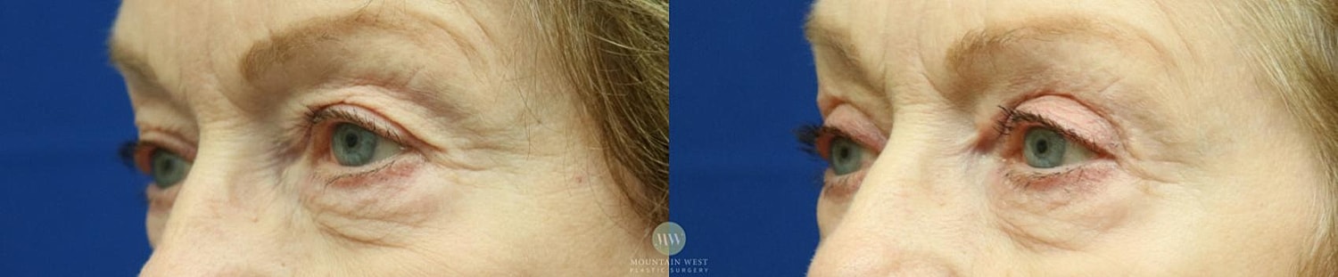 Blepharoplasty Before & After