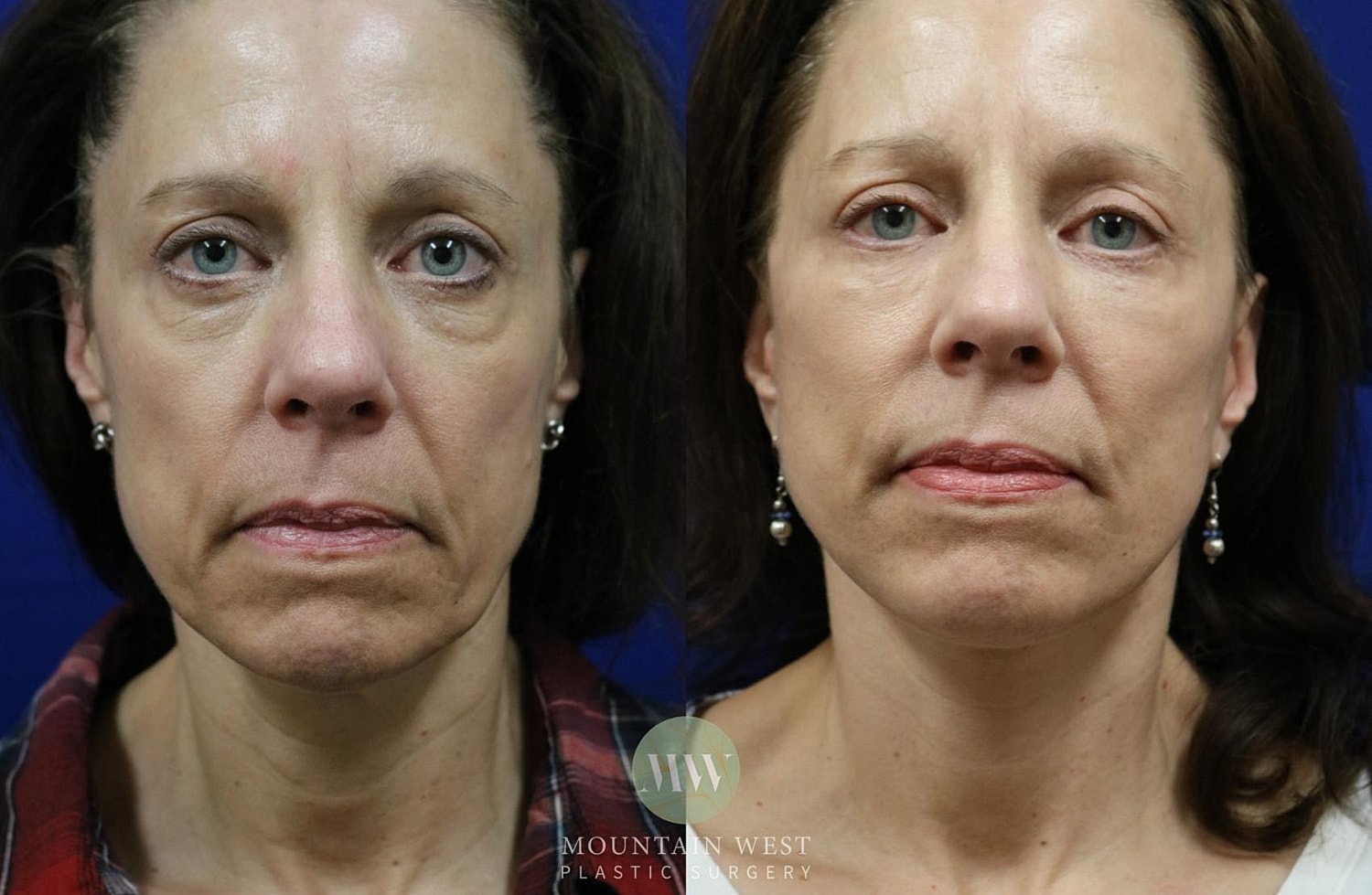 Blepharoplasty Before & After