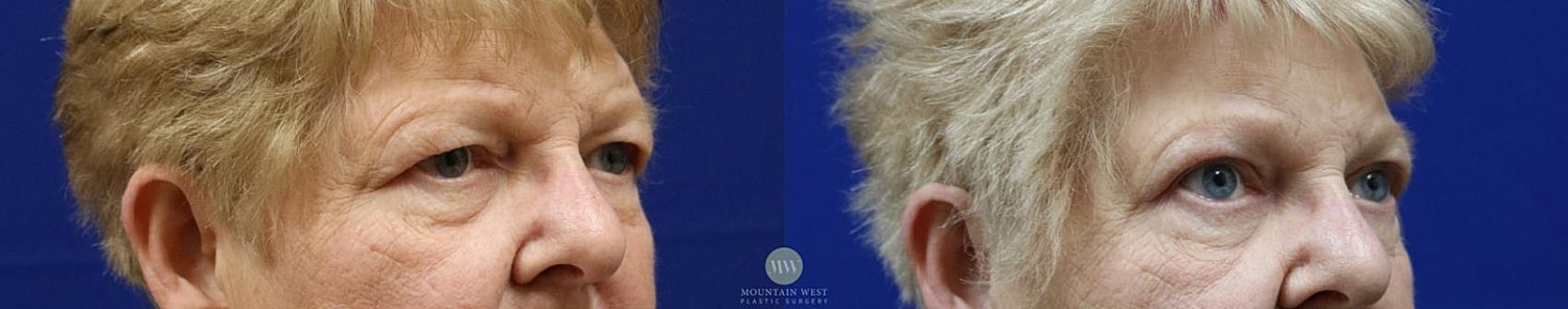 Blepharoplasty Before & After