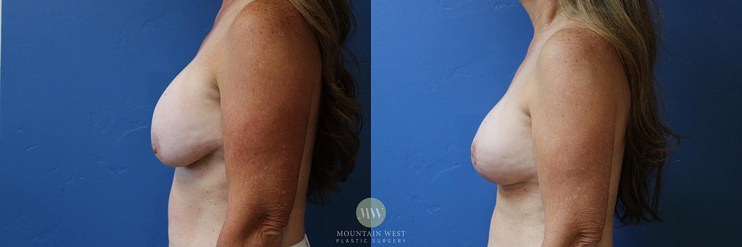 Breast Implant Removal Before & After
