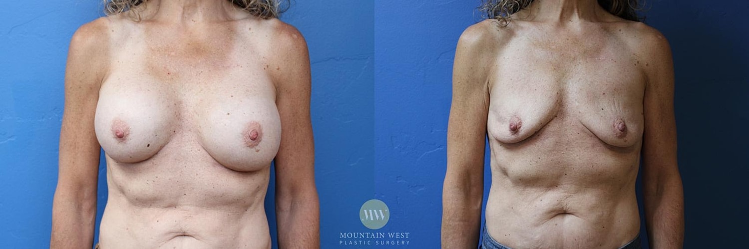 Breast Implant Removal Before & After
