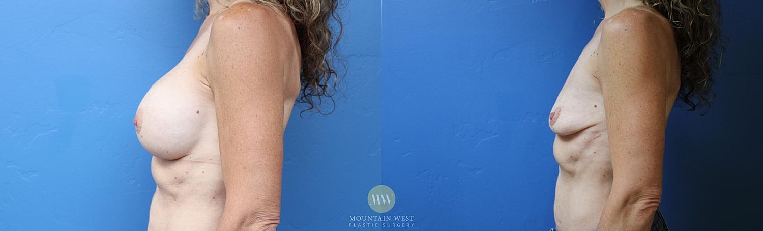 Breast Implant Removal Before & After