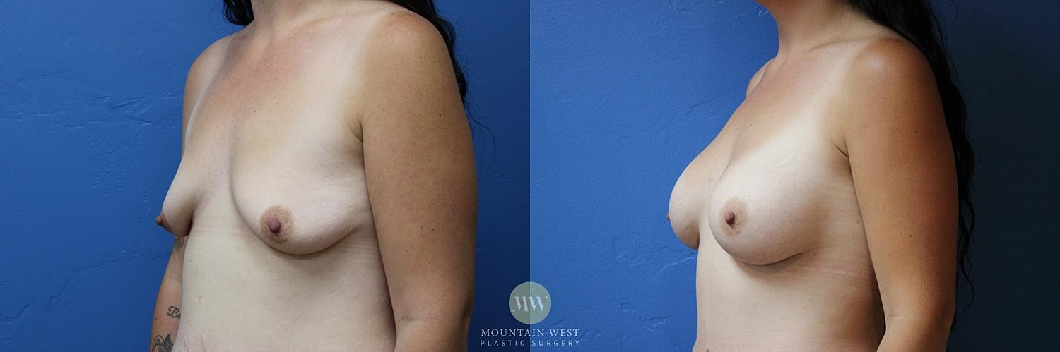 Breast Surgery After Weight Loss Before & After