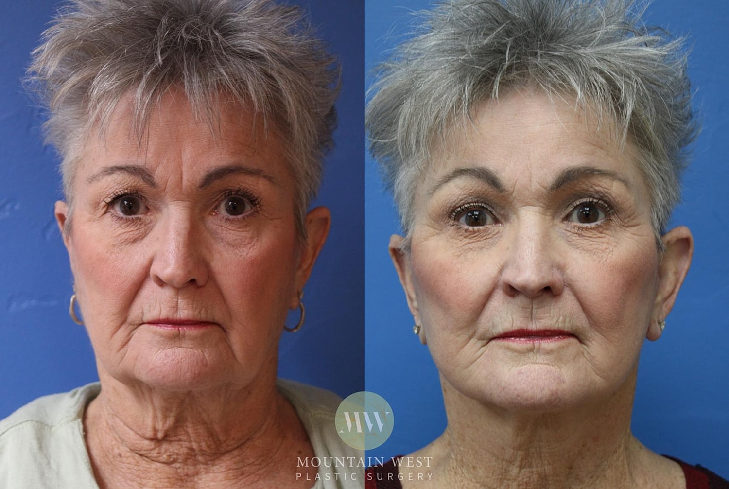 Facelift Before & After