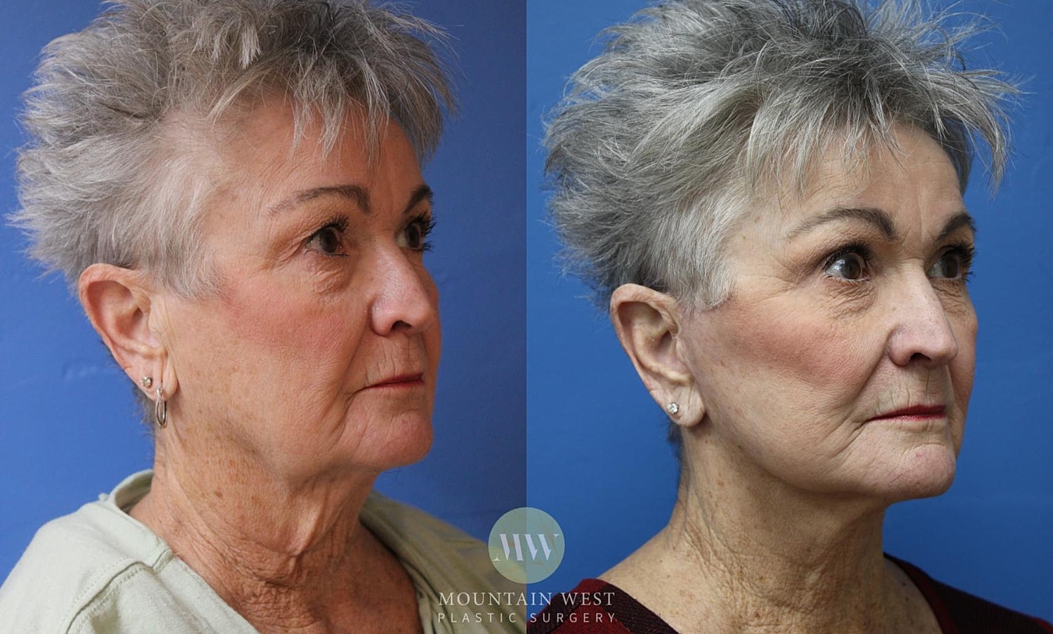 Facelift Before & After
