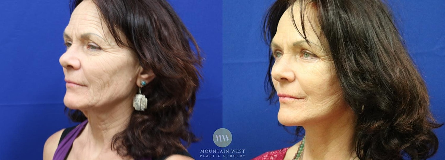 Facelift Before & After