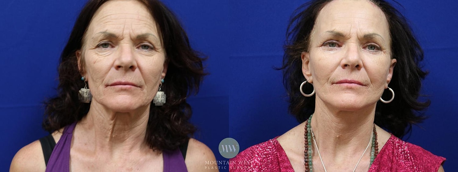 Facelift Before & After