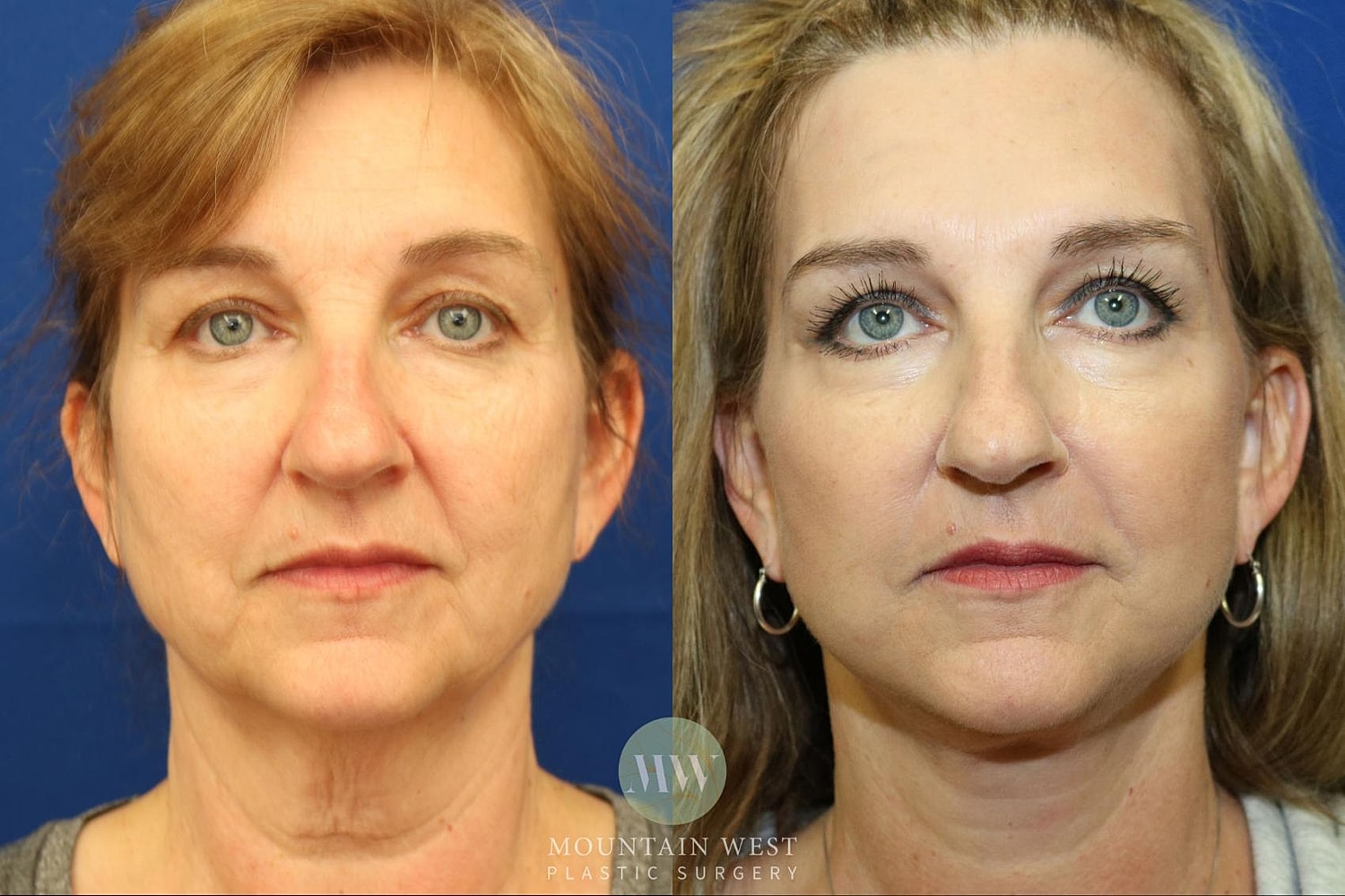 Facelift Before & After