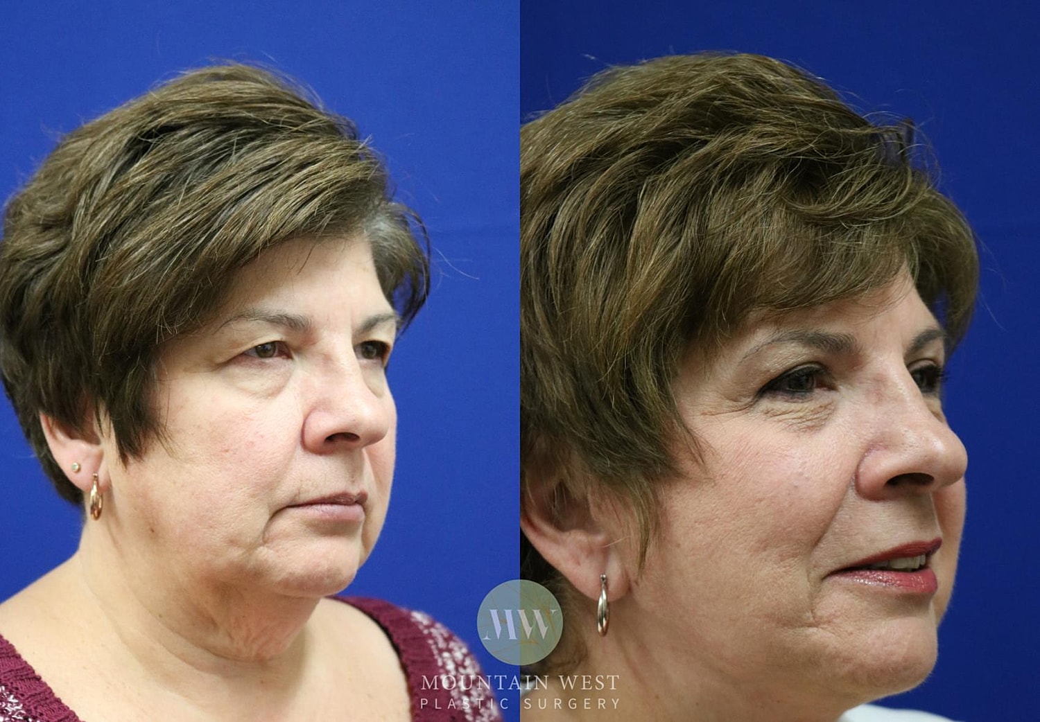 Facelift Before & After