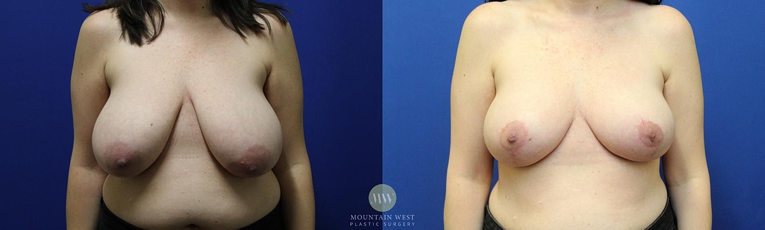 Breast Lift Before & After