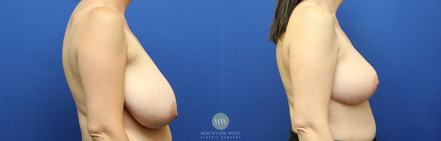 Breast Lift Before & After