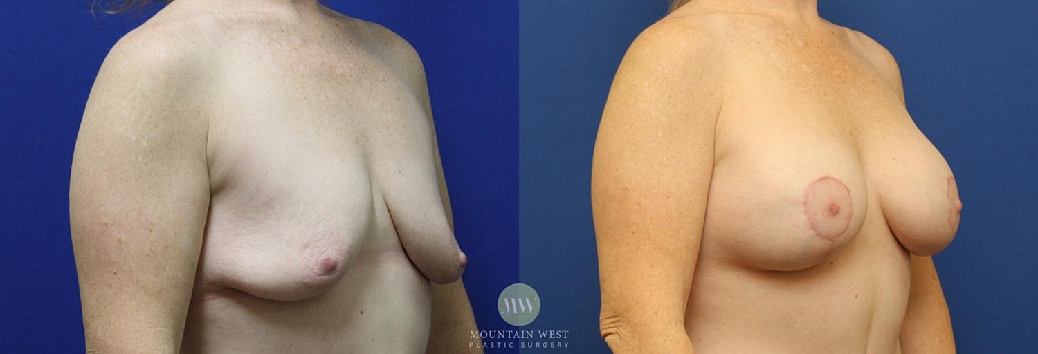 Breast Lift Before & After