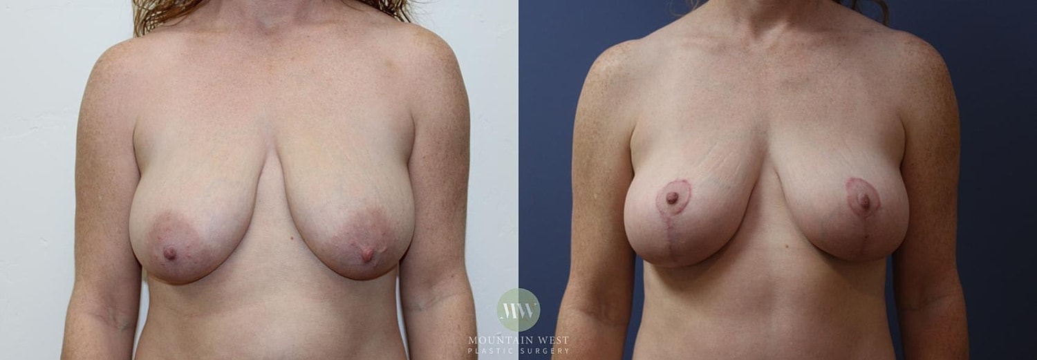 Breast Lift Before & After
