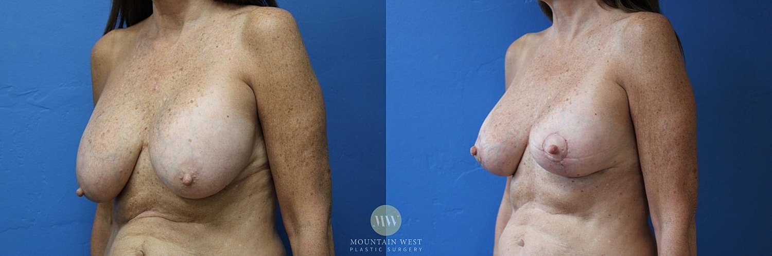 Breast Lift Before & After