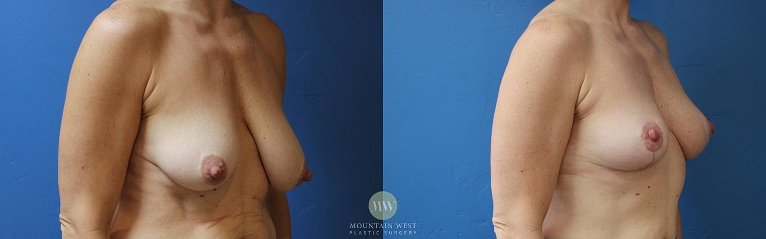 Breast Lift Before & After