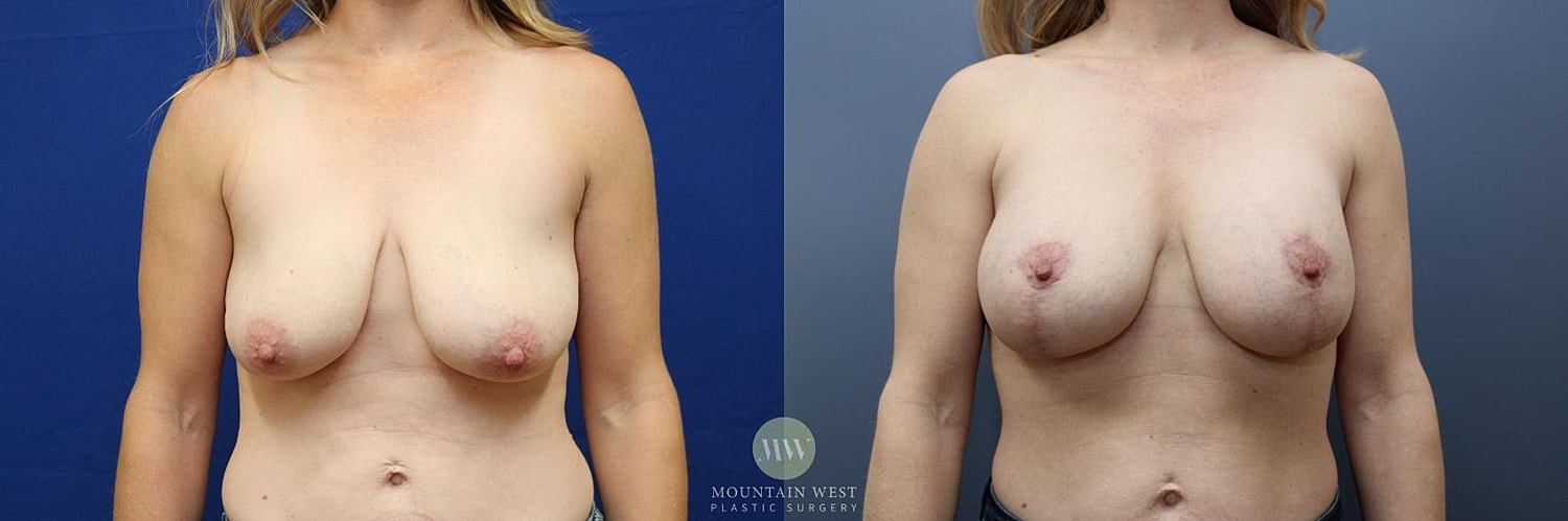 Breast Lift Before & After
