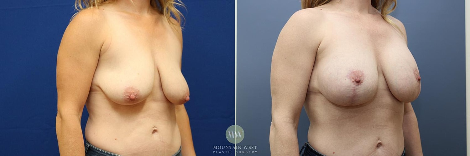 Breast Lift Before & After