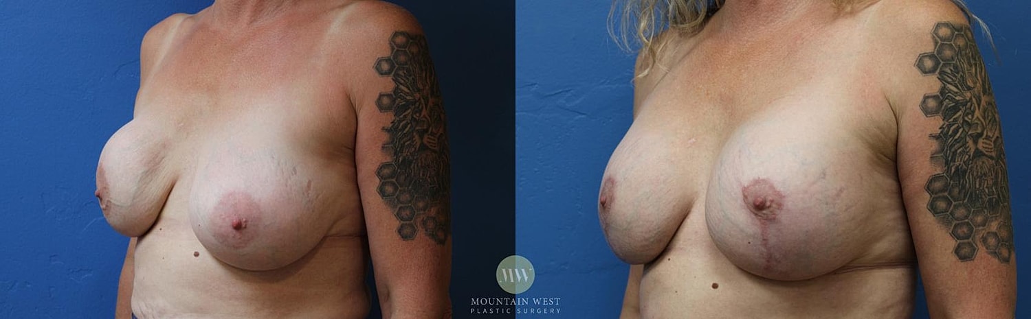 Breast Lift Before & After