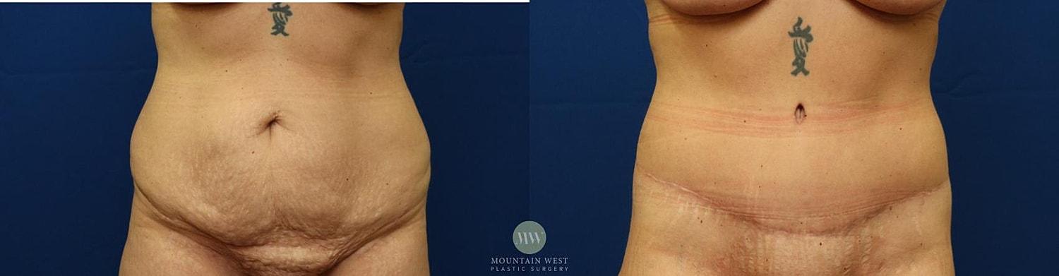Tummy Tuck Before & After