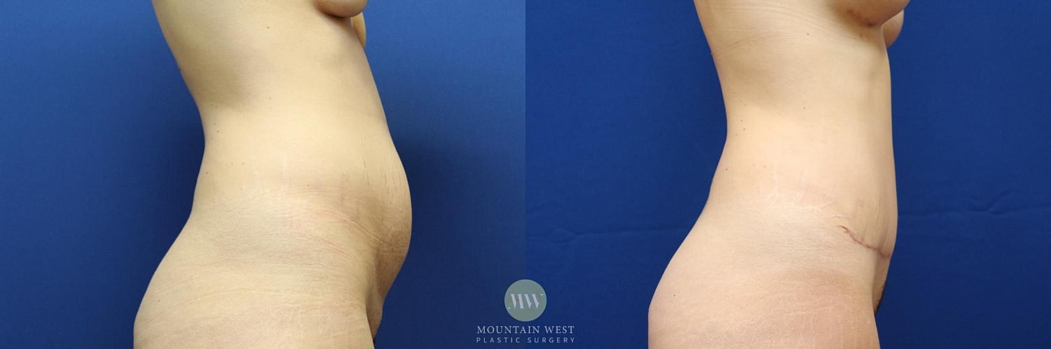 Tummy Tuck Before & After