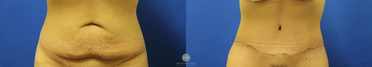 Tummy Tuck Before & After