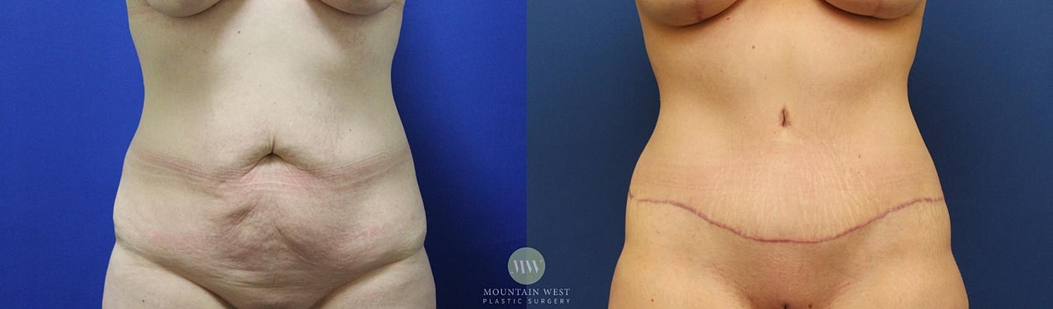 Tummy Tuck Before & After