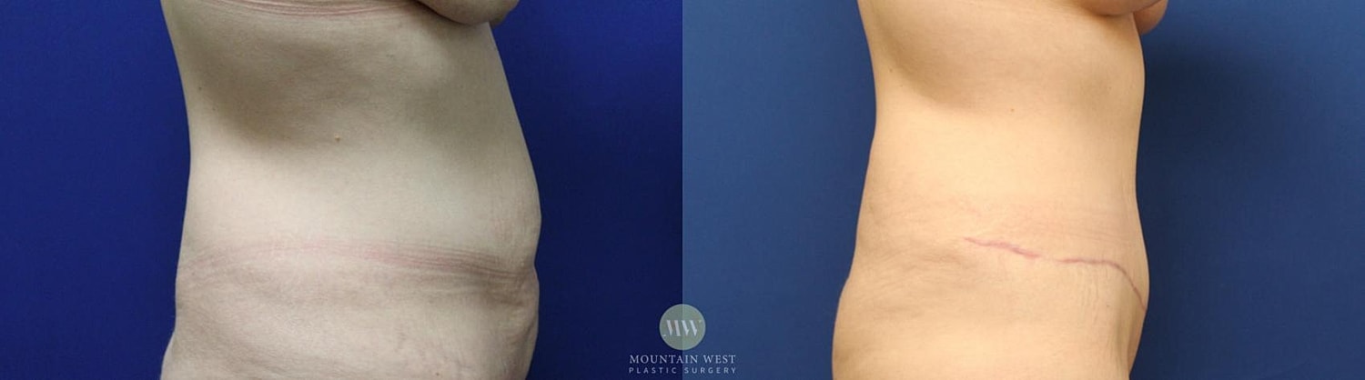 Tummy Tuck Before & After