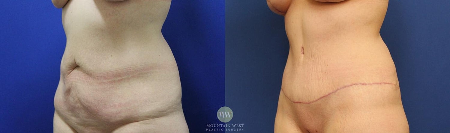 Tummy Tuck Before & After