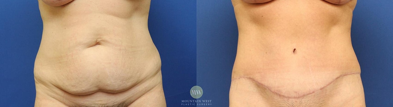 Tummy Tuck Before & After