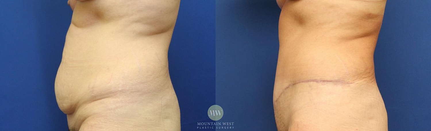 Tummy Tuck Before & After