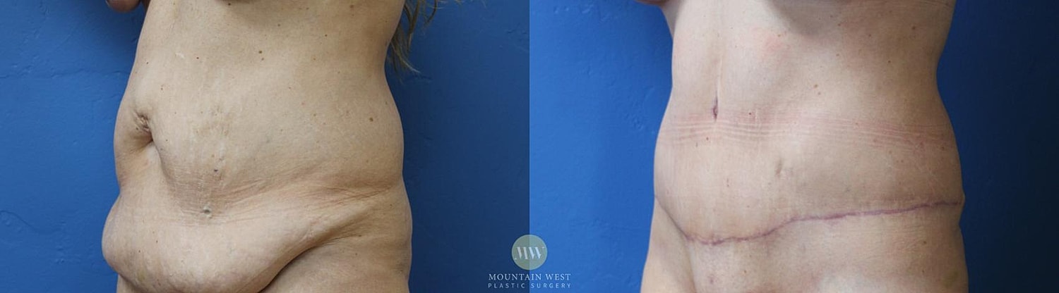 Tummy Tuck Before & After