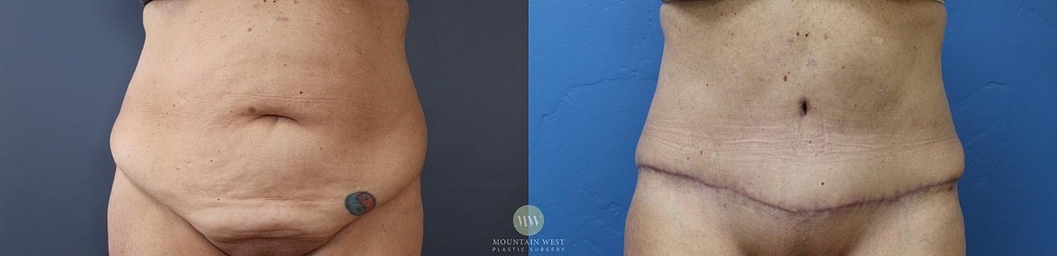Tummy Tuck Before & After