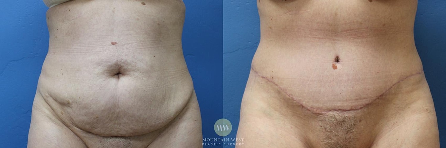 Tummy Tuck Before & After