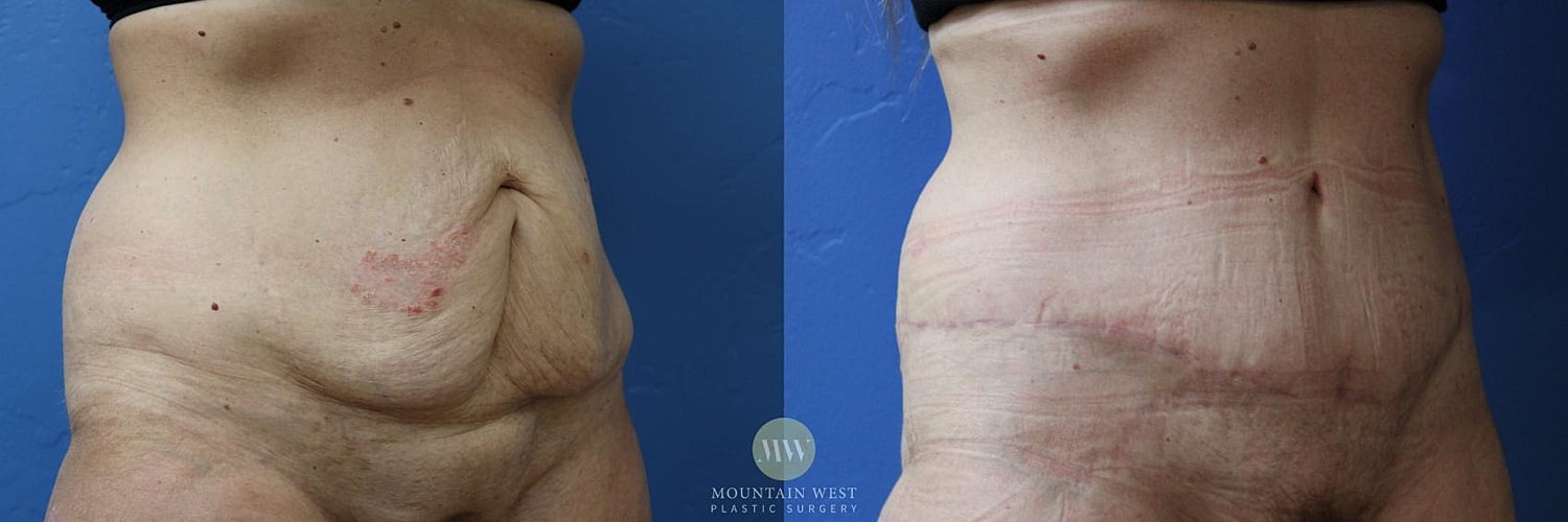 Tummy Tuck Before & After