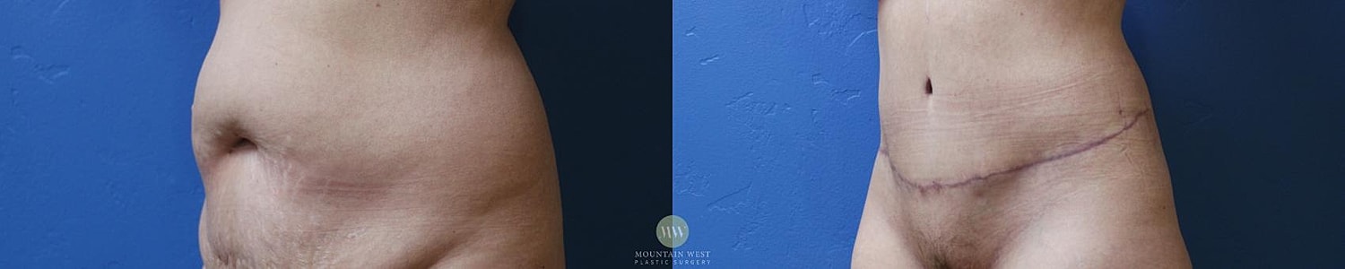 Tummy Tuck Before & After