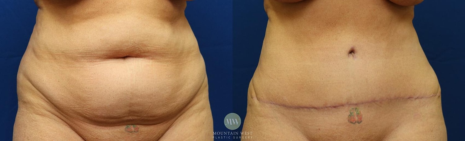 Tummy Tuck Before & After